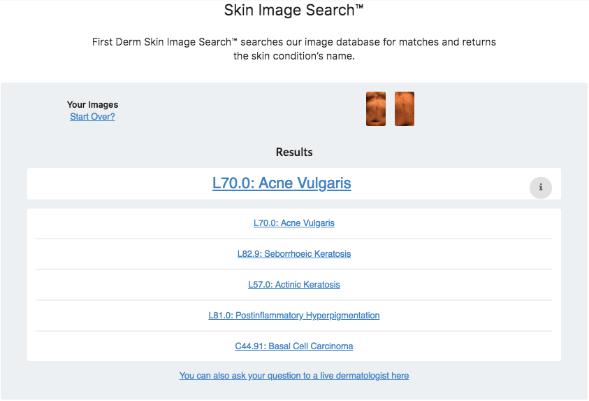 mejores prácticas del buscador de imágenes de la piel™ acne