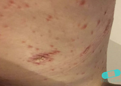 Psoriasis (02) torso [ICD-10 L40.9]