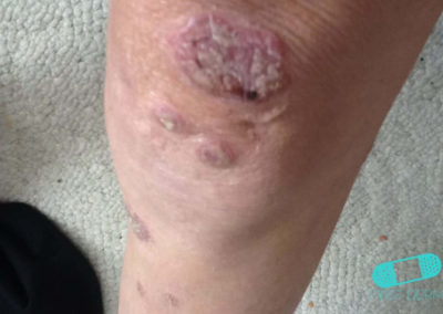 Psoriasis (03) rodilla [ICD-10 L40.9]