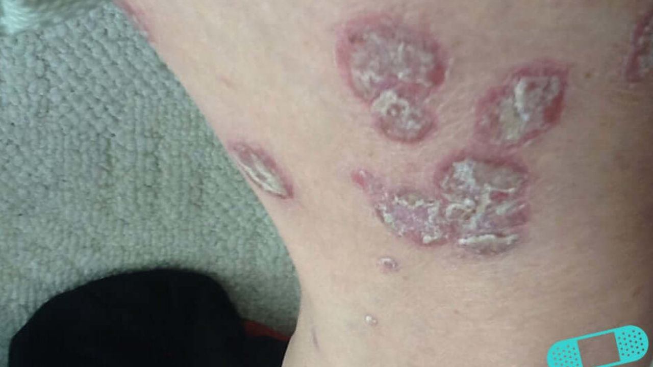 plaque psoriasis icd 10)