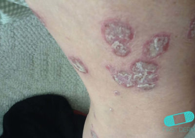 Psoriasis (01) pierna [ICD-10 L40.9]