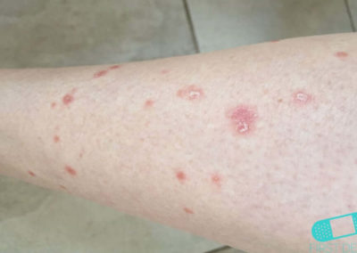 Psoriasis (12) höger ben [ICD-10 L40.9]