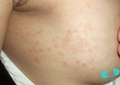 Psoriasis (18) mage [ICD-10 L40.9]