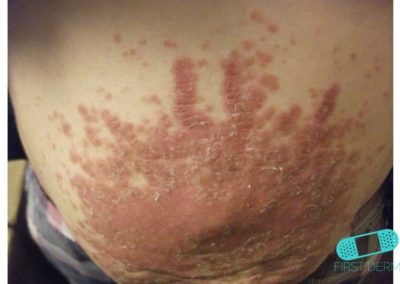 Psoriasis (04) estómago [ICD-10 L40.9]