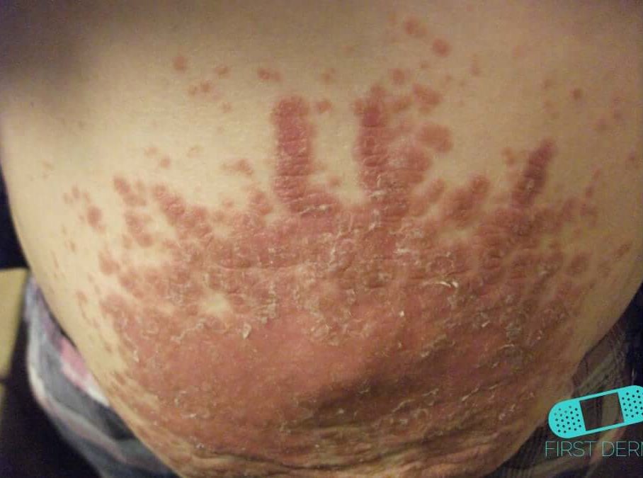plaque psoriasis icd 10