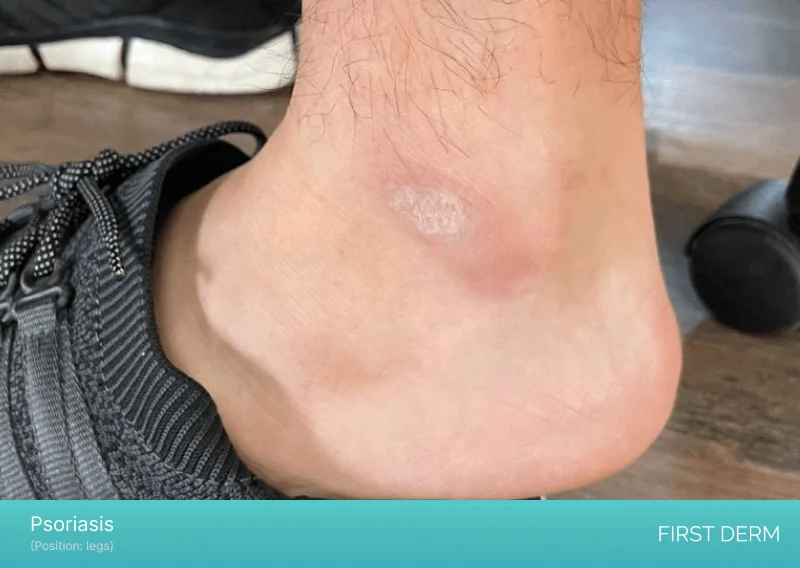 A photograph showing a light red patch on the ankle with white scales in the middle, indicating a possible case of psoriasis