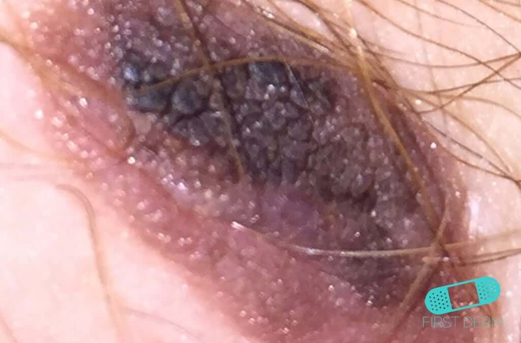 Queratosis Seborreica (Verrugas Seniles)