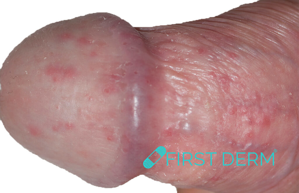Head penis of around dots sticky glans,foreskin