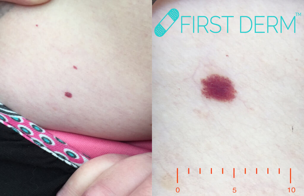 Red spots on skin Pictures treatment angioma stomach ICD 10 D18.00