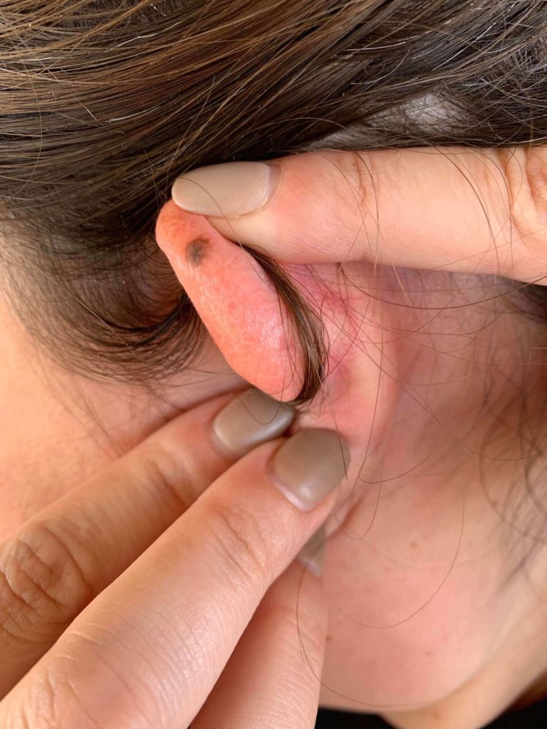 seborrheic dermatitis ear reddit