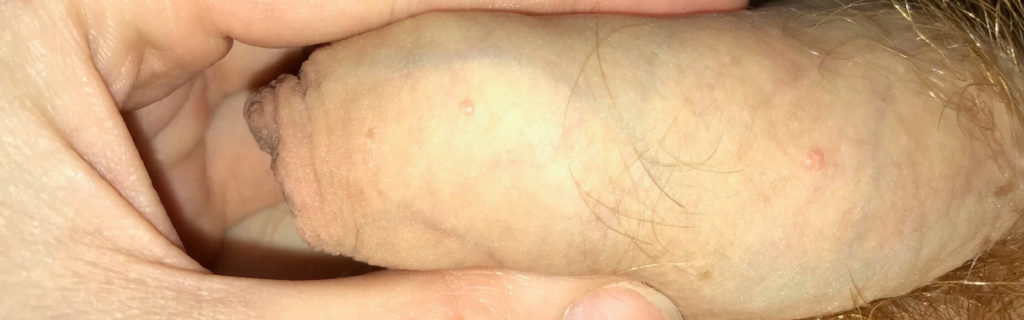 Reddit Skincare molluscum contagiosum penis shaft help