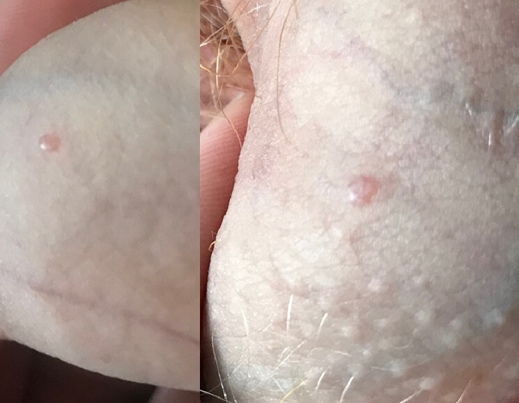 Wart treatment reddit, Wart treatment reddit - Metastatic cancer and lymphoma
