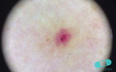 Rötsår (ulcus) – bensår