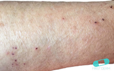 Scabies