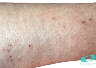 Scabies (01) arm [ICD-10 B86]