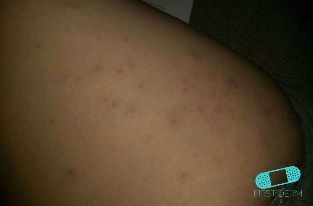 Scabies (18) arm [ICD-10 B86]