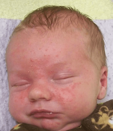 Online Dermatology - A Hands-Off Approach to Newborn Acne