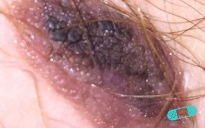 Seborroisk keratos (senilvårtor)