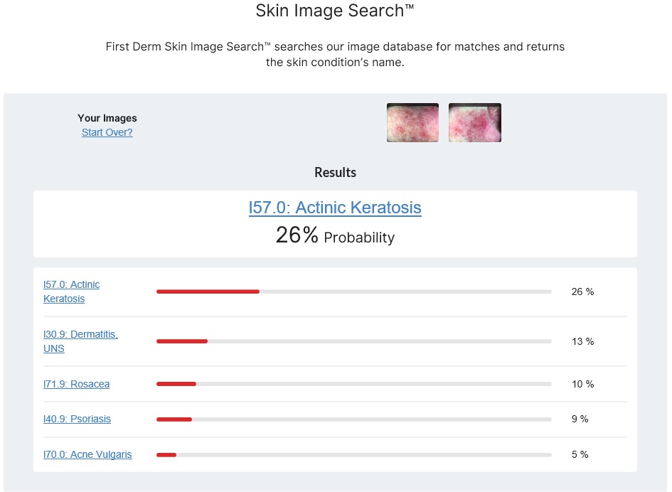 Skin Image Search™ Testimonial - Pre cancerous lesion - Actinic Keratosis