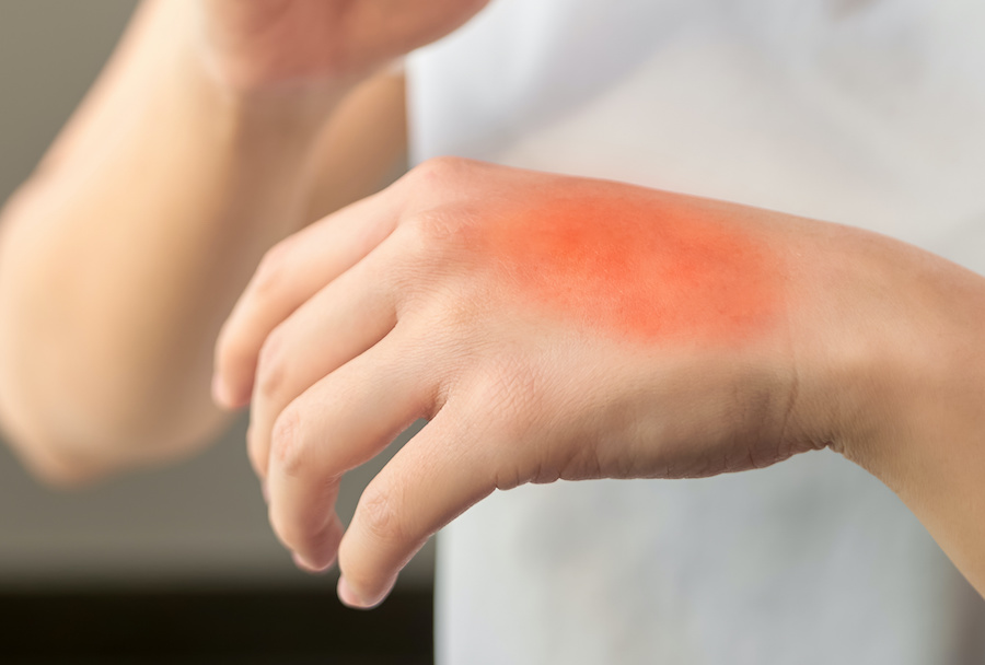 life-threatening-skin-rashes
