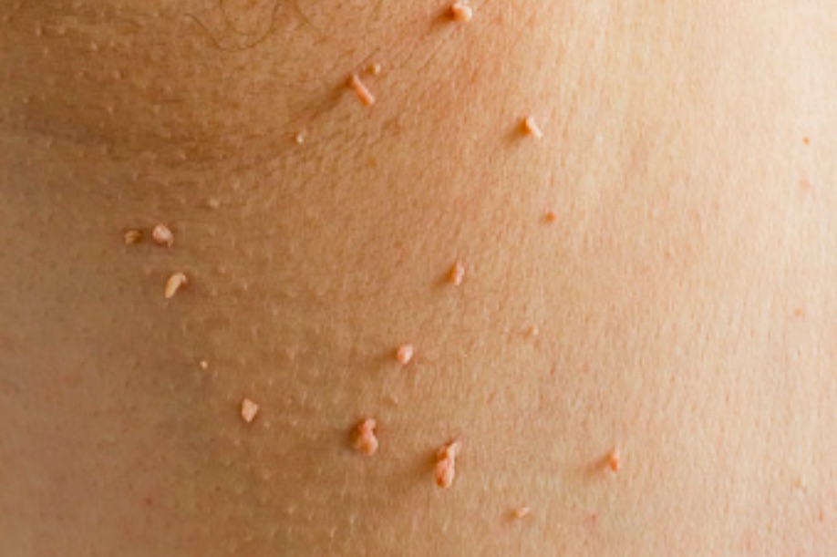 What are Skin Tags – Are they a Sign of Cancer?