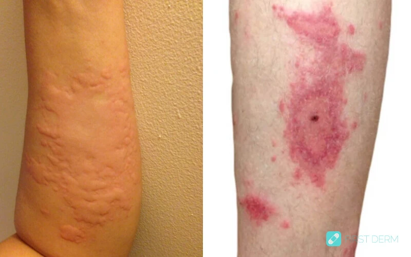 Skin rash urticaria hives involved with mental health and skin condition, appearing in left arm legs