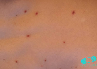 Spots and Rashes Caused by Viruses (01) skin [ICD-10 B34.9]
