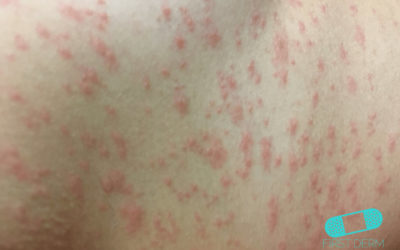 Spots and Rashes Caused by Viruses – Exanthem