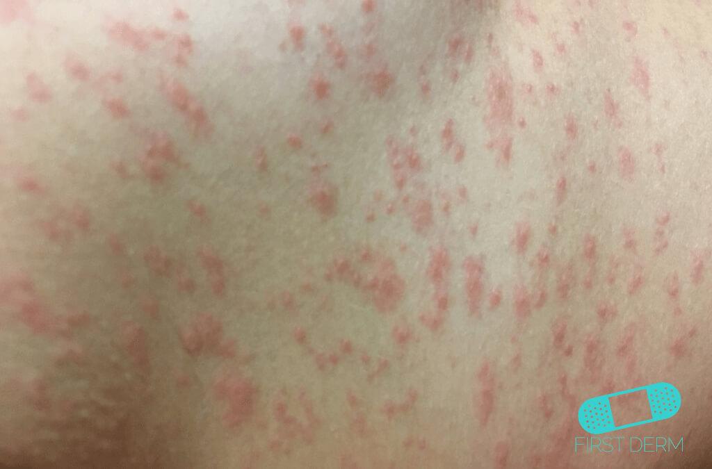 Spots and Rashes Caused by Viruses (02) skin [ICD-10 B34.9]