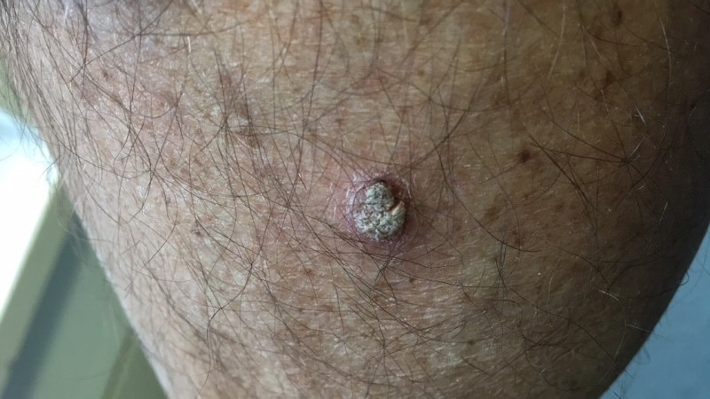 Squamous cell carcinoma pictures skin cancer 