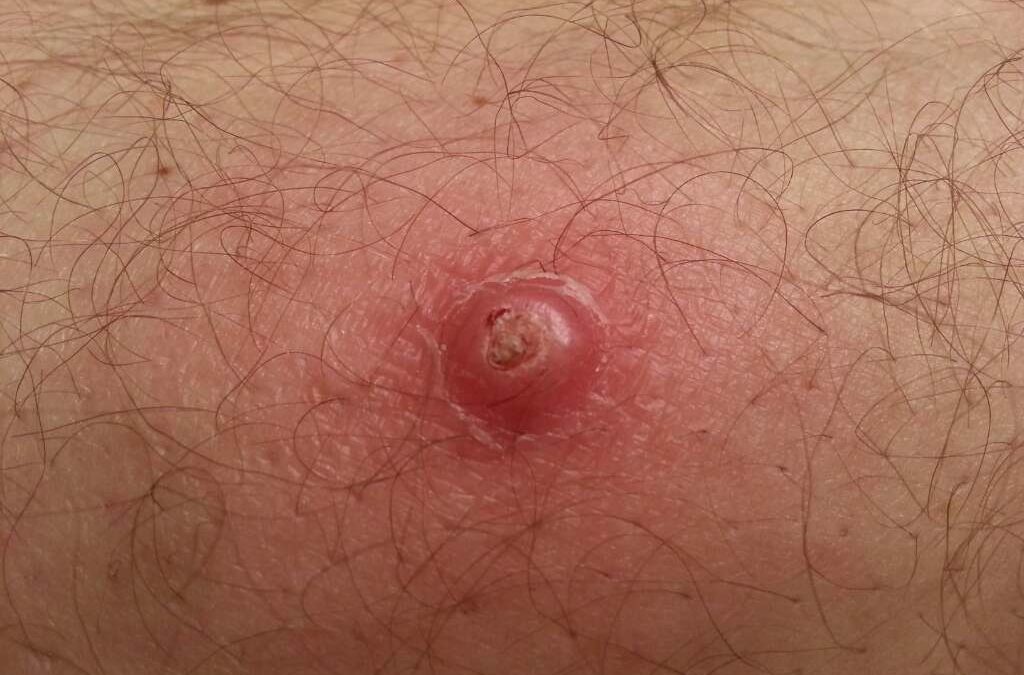 Squamous Cell Carcinoma