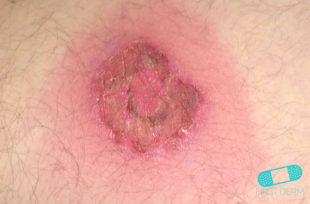 Svinkoppor (impetigo)