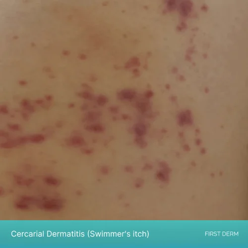 swimmer’s itch in the initial stage with tiny flat red spots on skin