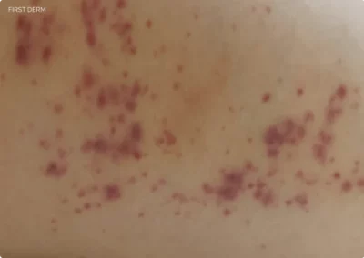 swimmer’s itch on hand in the initial stage with tiny flat red spots