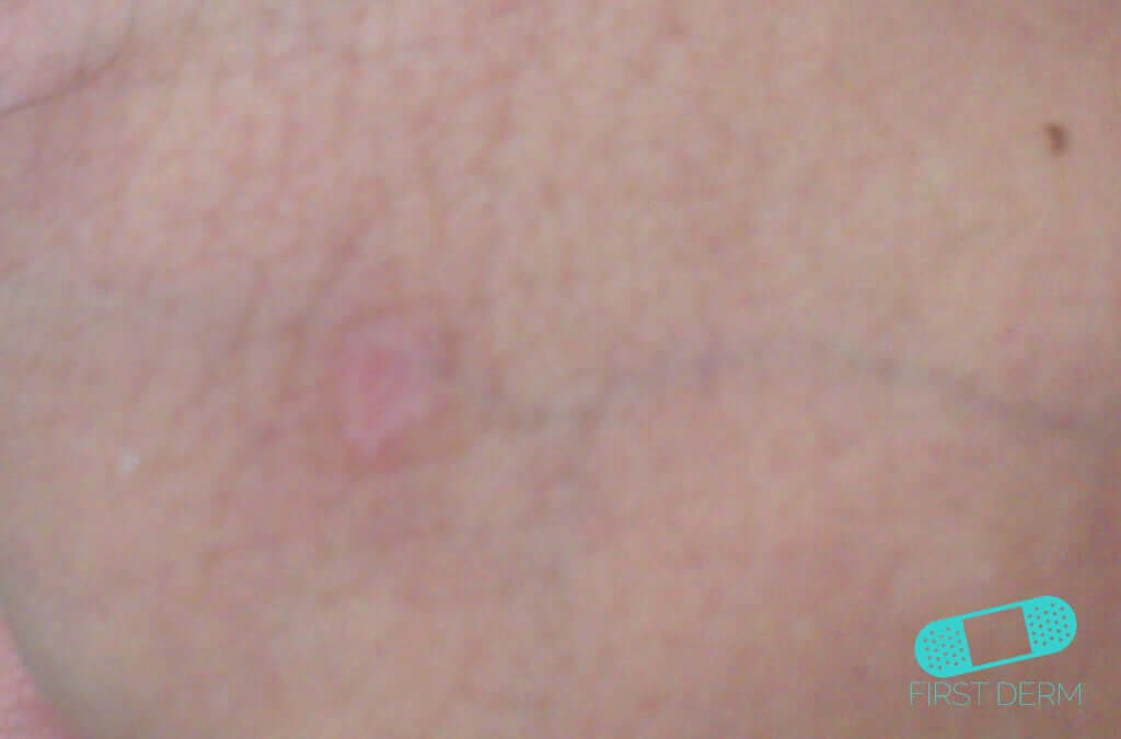 Syphilis