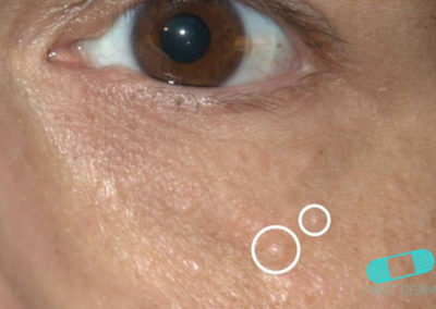 Syringoma (01) eyelids cheek [ICD-10 G95.0]