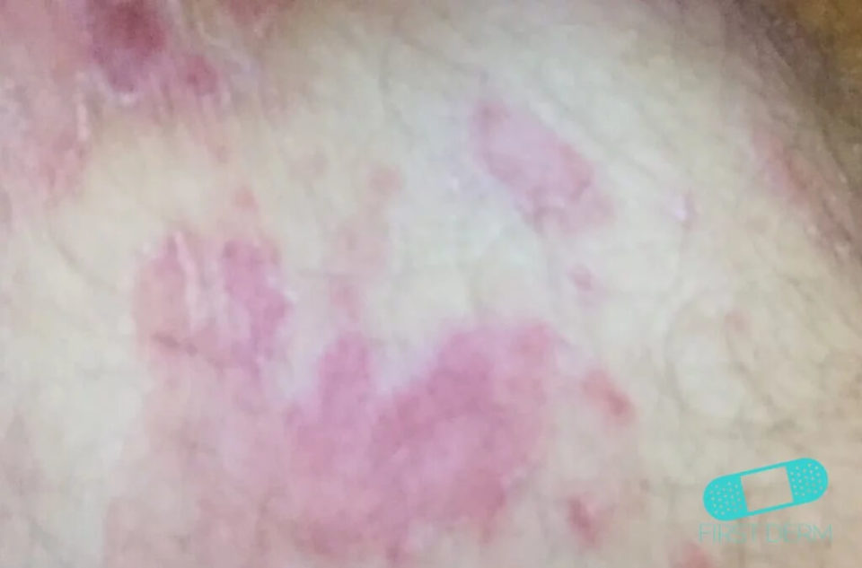 Tinea Corporis (Ringworm) - Online Dermatology