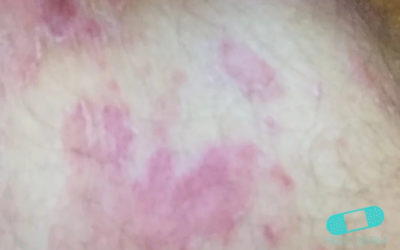 Tinea Corporis (tiña)