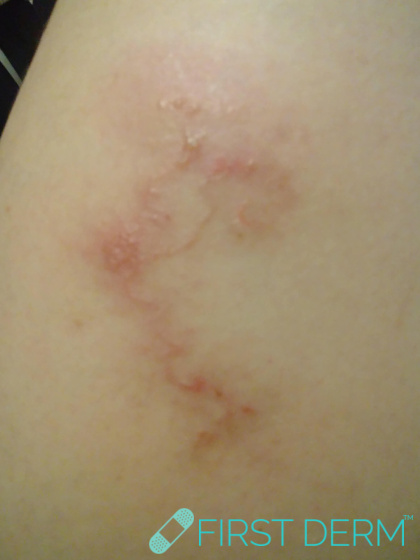 Travel rash CUTANEOUS LARVA MIGRANS parasite on leg