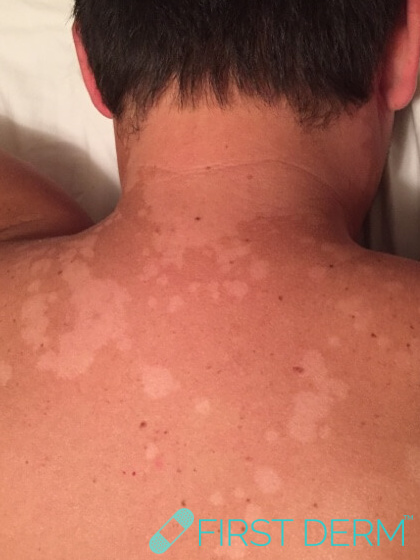 Pityriasis Versicolor (Tinea Verisicolor) - Online Dermatologist