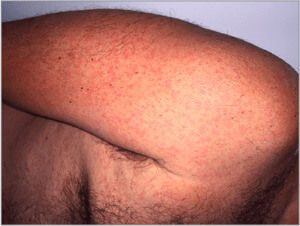 Zikavirus (utslag) (03) arm [ICD-10 A92.5]