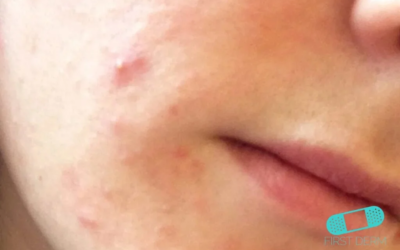 Acne from steroids: Symptoms, causes and what you can do