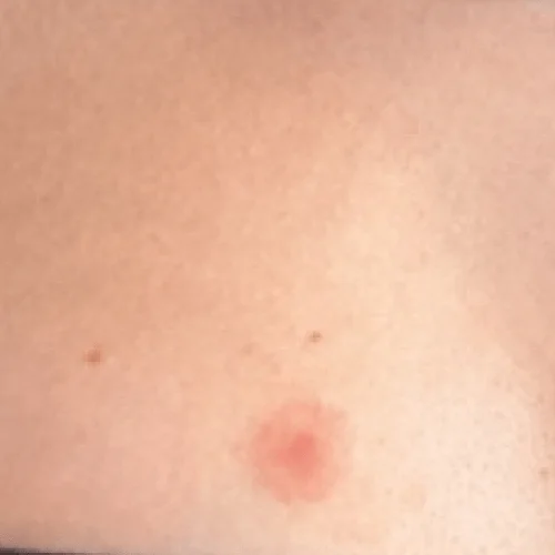 Breast Rashe Image Breast Eczema | Symptoms, Causes & Treatment