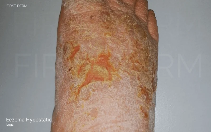 Eczema Hypostatic on lower legs showing symptoms such as redness, scaling, weeping areas, and swelling, indicating severe skin inflammation