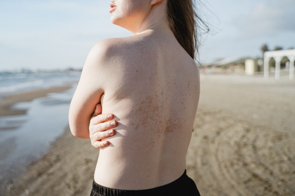 Climate Change: Girl on the beach with sunspots on her back