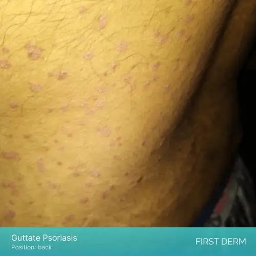 Image of a person with brown skin tone experiencing Guttate Psoriasis on their back. The affected area appears as small, red, scaly patches scattered across the skin 