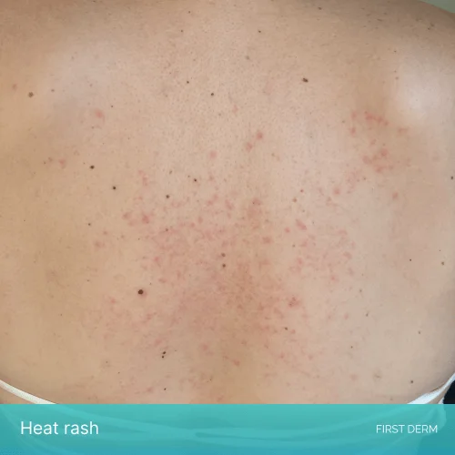 A woman’s upper back showing signs of heat rash, such as small red or pink dots and black dot