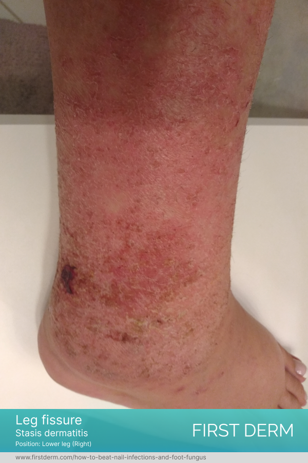 leg skin fissure, with surrounding dry and discolored skin