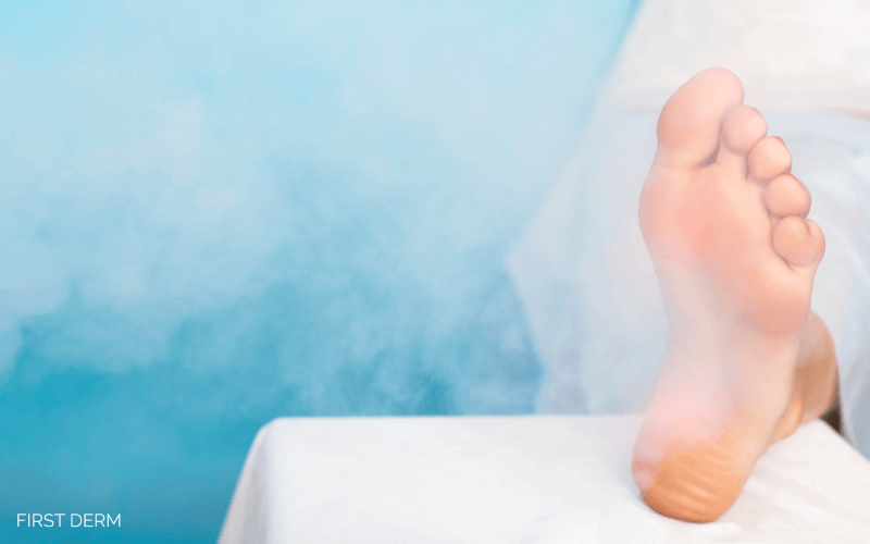 Close-up of liquid nitrogen cryotherapy treatment for Verruca Vulgaris on a person's foot