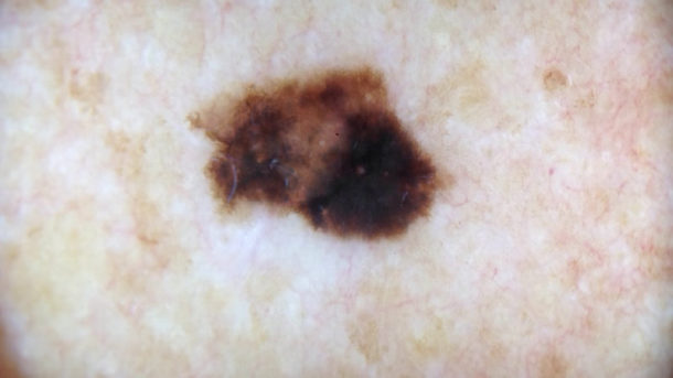 Melanoma Pictures and Malignant Tumor of The Skin - Online Dermatology